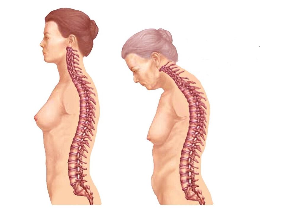 изогнутый здоровый позвоночник с остеохондрозом